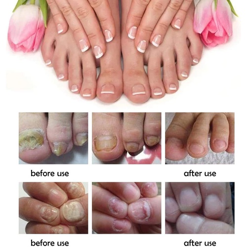  Cherioll Nail Repair, Nail Repair Solution, Toenail Treatment, Effective Against Nail Infection Restores Discolored & Damaged Nails
