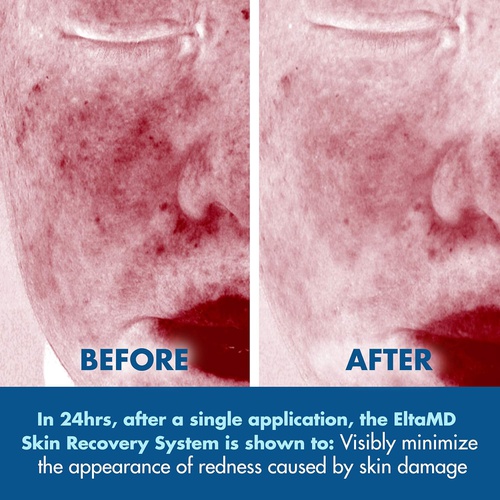  EltaMD Skin Recovery System Facial Skin Care Set includes Gentle Essence Toner, Serum and Light Moisturizer, 3-Piece Set